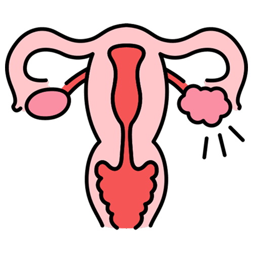 Polycystic Ovary Syndrome